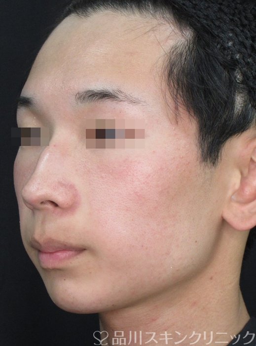 症例NO.73057のBEFORE写真