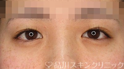 症例NO.63403のBEFORE写真