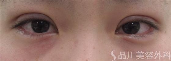 症例NO.20646のAFTER写真