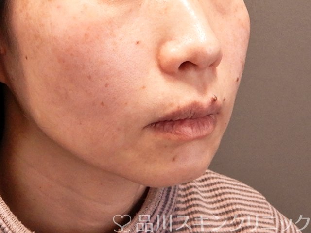 症例NO.70489のAFTER写真