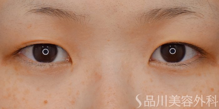 症例NO.70682のBEFORE写真