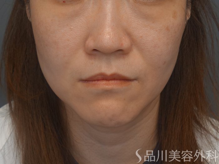症例NO.74238のBEFORE写真