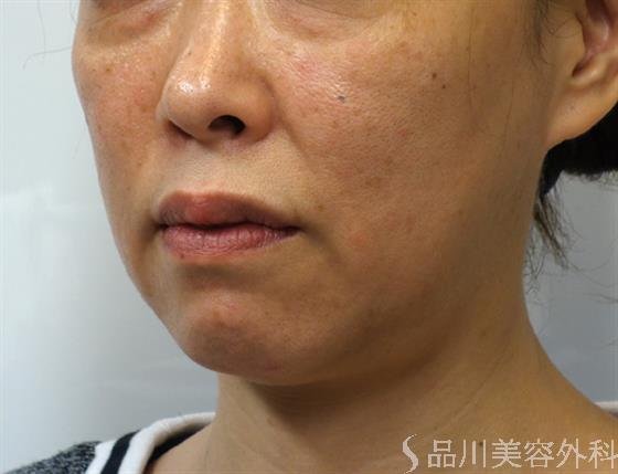 症例NO.40179のBEFORE写真