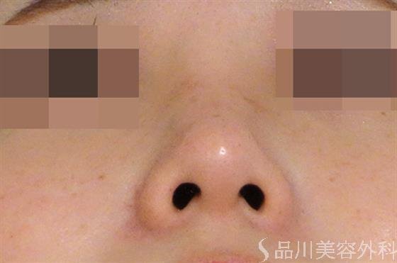 症例NO.39018のAFTER写真