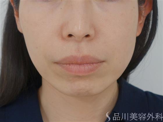 症例NO.33470のBEFORE写真