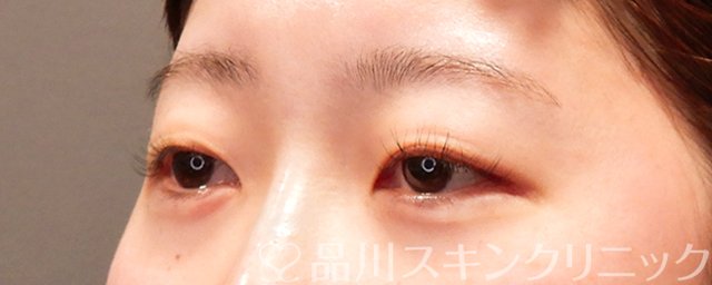 症例NO.69366のAFTER写真