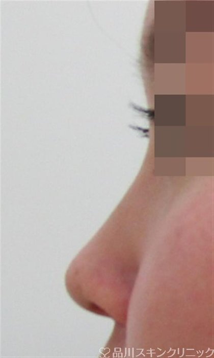 症例NO.32659のBEFORE写真