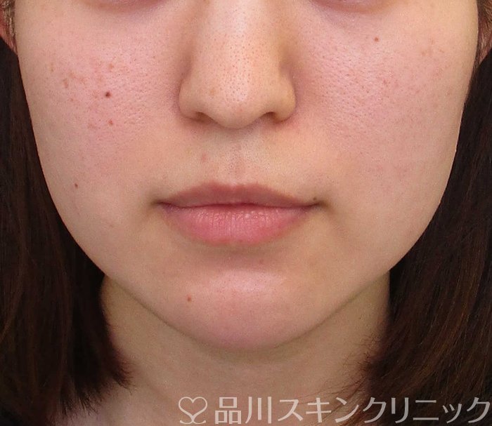 症例NO.65066のBEFORE写真