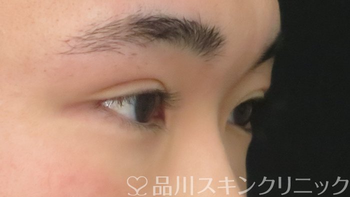 症例NO.69553のAFTER写真