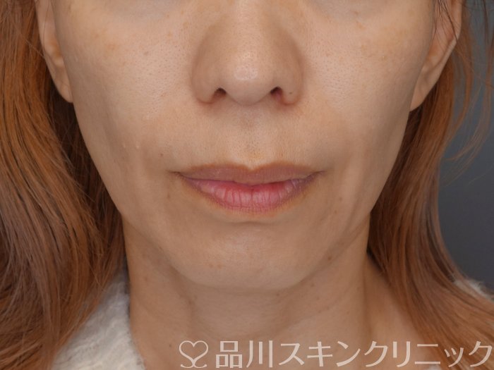 症例NO.72759のBEFORE写真