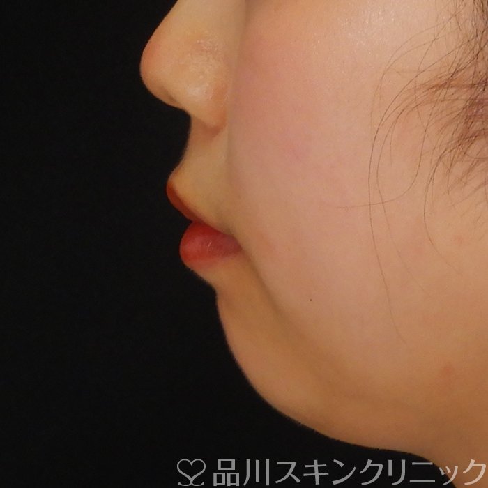 症例NO.69764のBEFORE写真