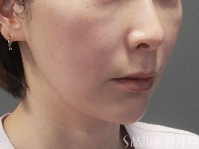 症例NO.70138のBEFORE写真