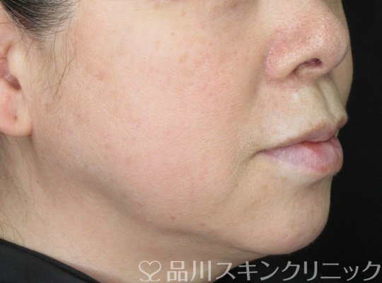 症例NO.70042のAFTER写真