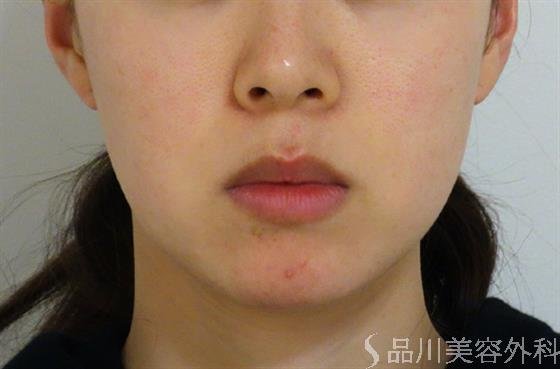 症例NO.47414のBEFORE写真