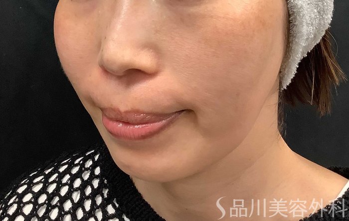 症例NO.71036のBEFORE写真