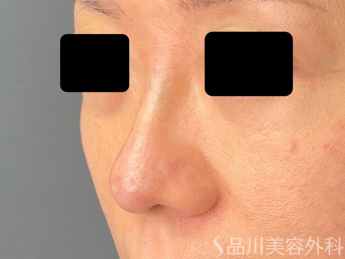 症例NO.72343のAFTER写真