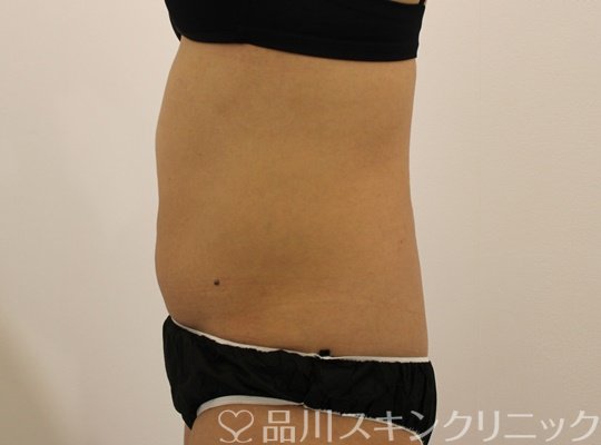 症例NO.69500のBEFORE写真