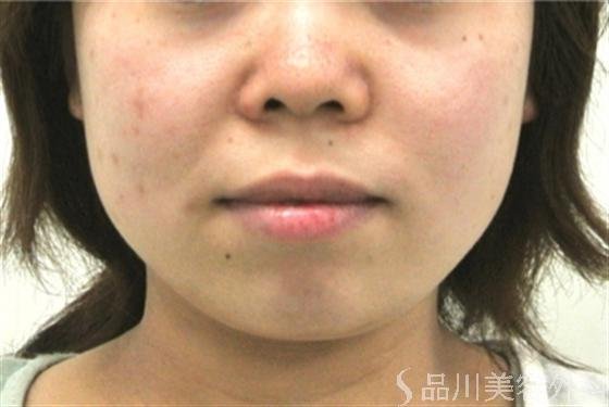 症例NO.14315のBEFORE写真