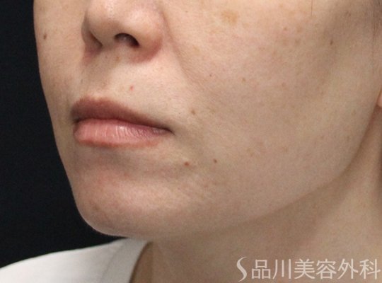 症例NO.74960のBEFORE写真