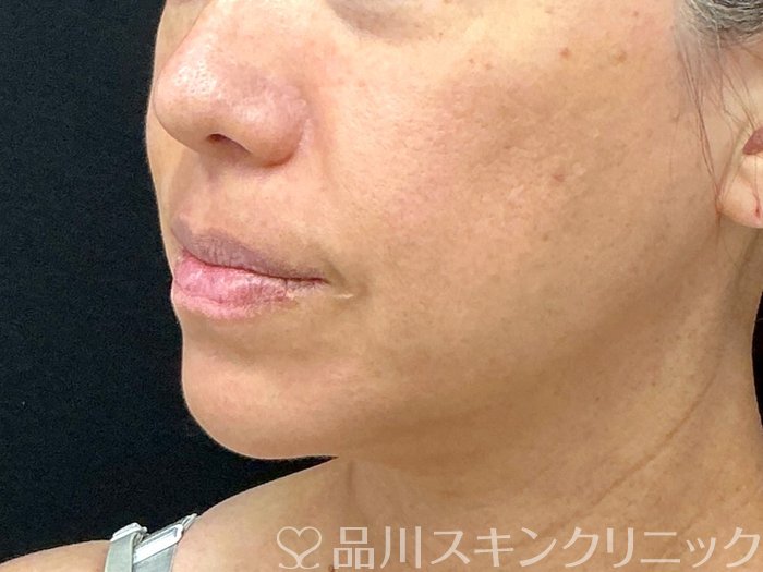 症例NO.74336のBEFORE写真