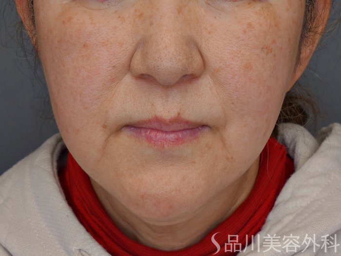 症例NO.73822のBEFORE写真