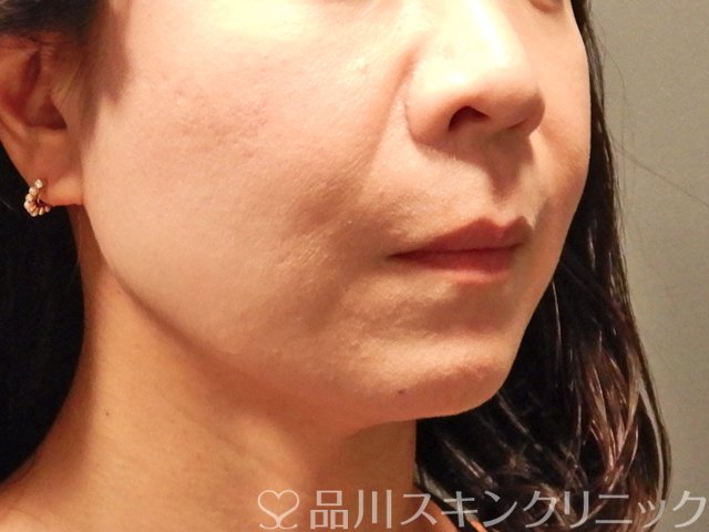 症例NO.63787のBEFORE写真