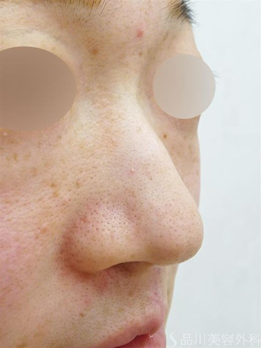 症例NO.46596のBEFORE写真