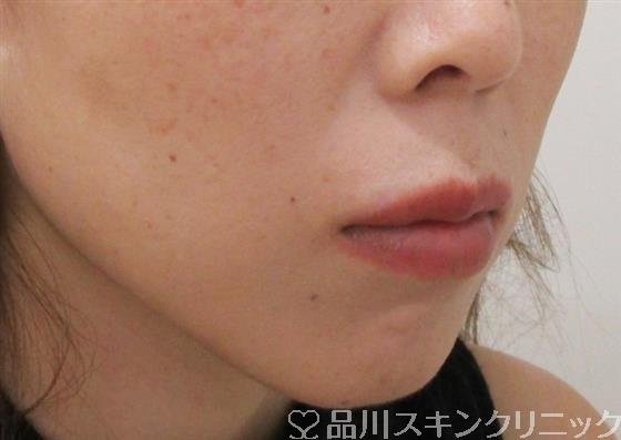 症例NO.37530のBEFORE写真