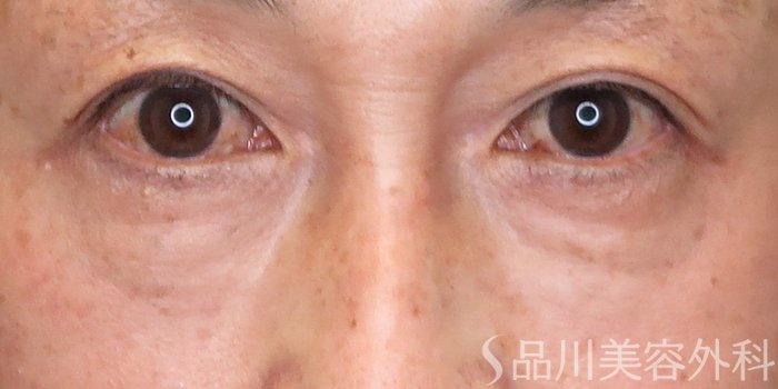 症例NO.71559のBEFORE写真