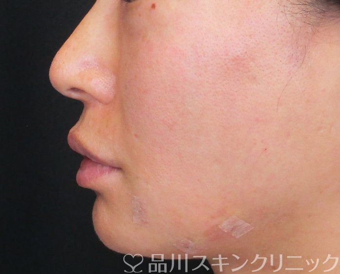 症例NO.72825のAFTER写真