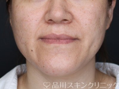 症例NO.64225のBEFORE写真
