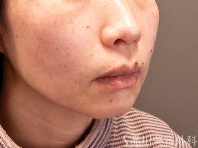 症例NO.70489のAFTER写真