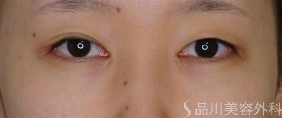 症例NO.52942のBEFORE写真