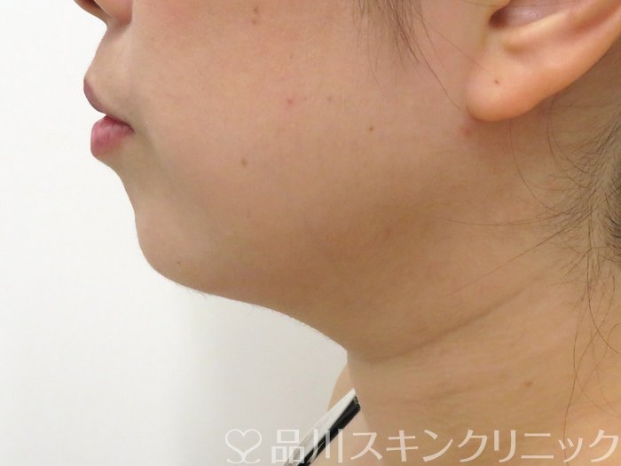 症例NO.72037のAFTER写真