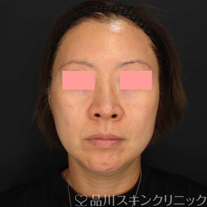 症例NO.71074のBEFORE写真