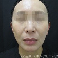 症例NO.71695のAFTER写真