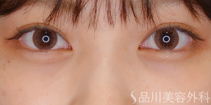 症例NO.69751のAFTER写真