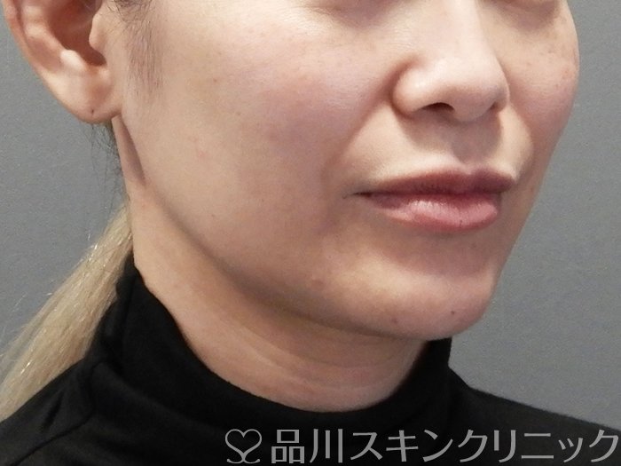 症例NO.72852のBEFORE写真