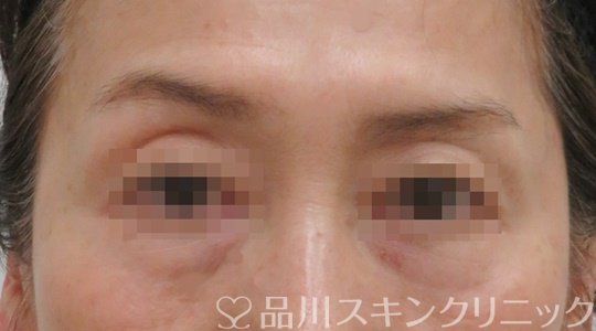 症例NO.71164のAFTER写真