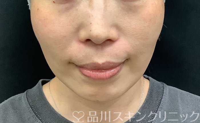 症例NO.71036のAFTER写真