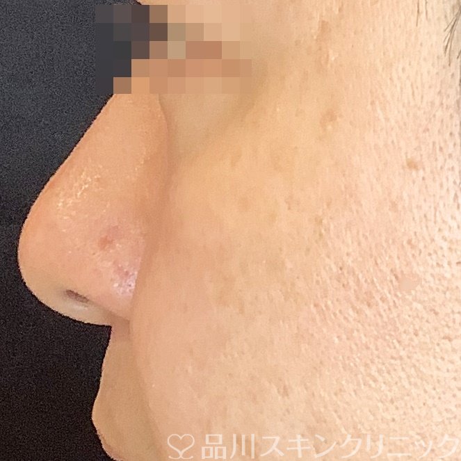 症例NO.66770のAFTER写真