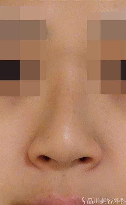 症例NO.44654のBEFORE写真