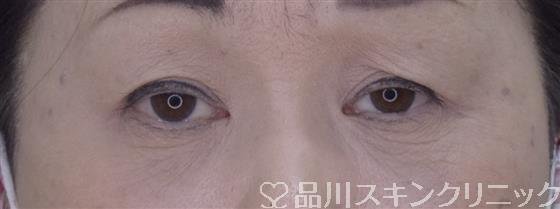 症例NO.52505のAFTER写真