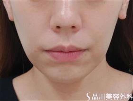 症例NO.47377のBEFORE写真