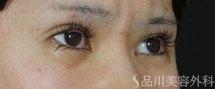 症例NO.72114のAFTER写真