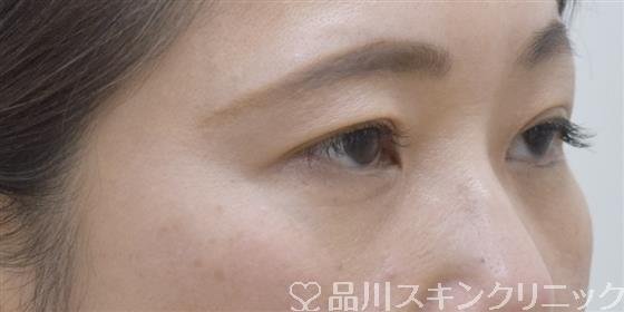 症例NO.54325のAFTER写真
