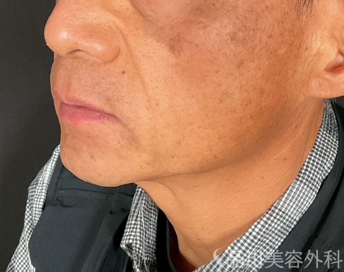 症例NO.75000のBEFORE写真