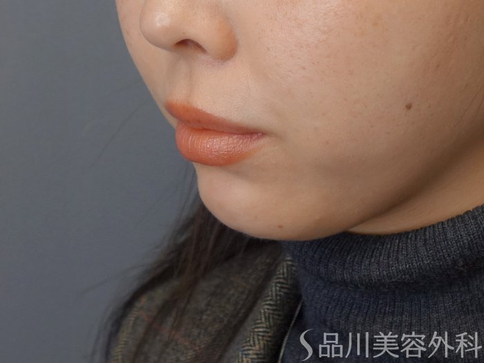 症例NO.72601のBEFORE写真