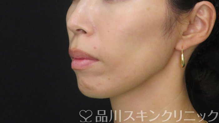 症例NO.72232のBEFORE写真