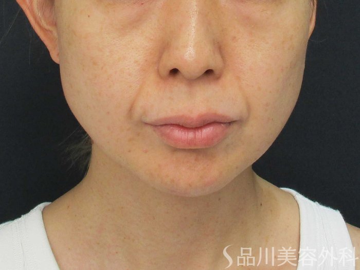 症例NO.69199のBEFORE写真